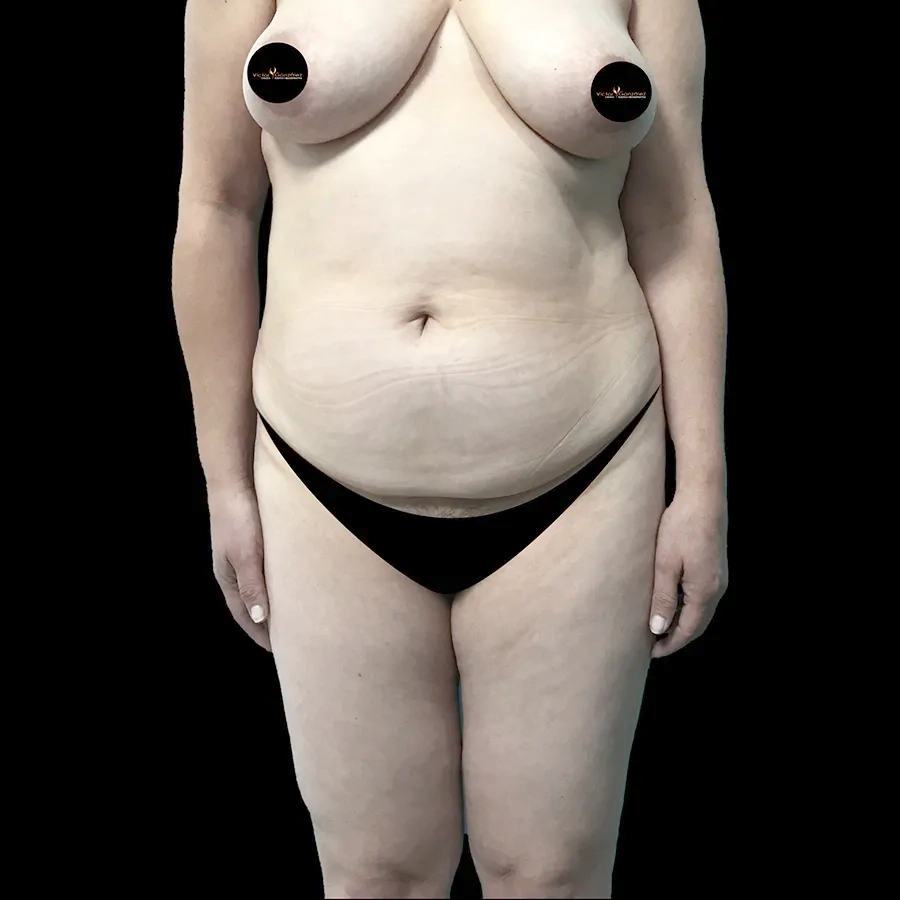 Caso clínico de valoración preoperatoria para abdominoplastia y flacidez abdominal con el Dr. Víctor González