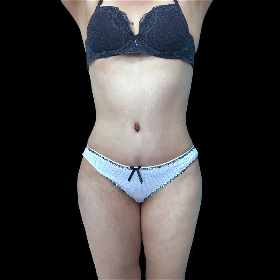 Resultado postoperatorio de abdominoplastia con tensión muscular y definición de cintura por el Dr. Víctor González