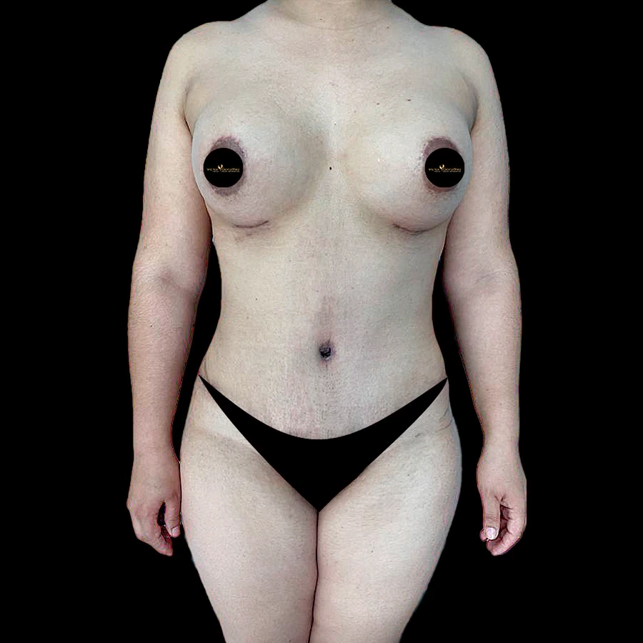 Resultado postoperatorio de abdominoplastia con firmeza y definición abdominal por el Dr. Víctor González