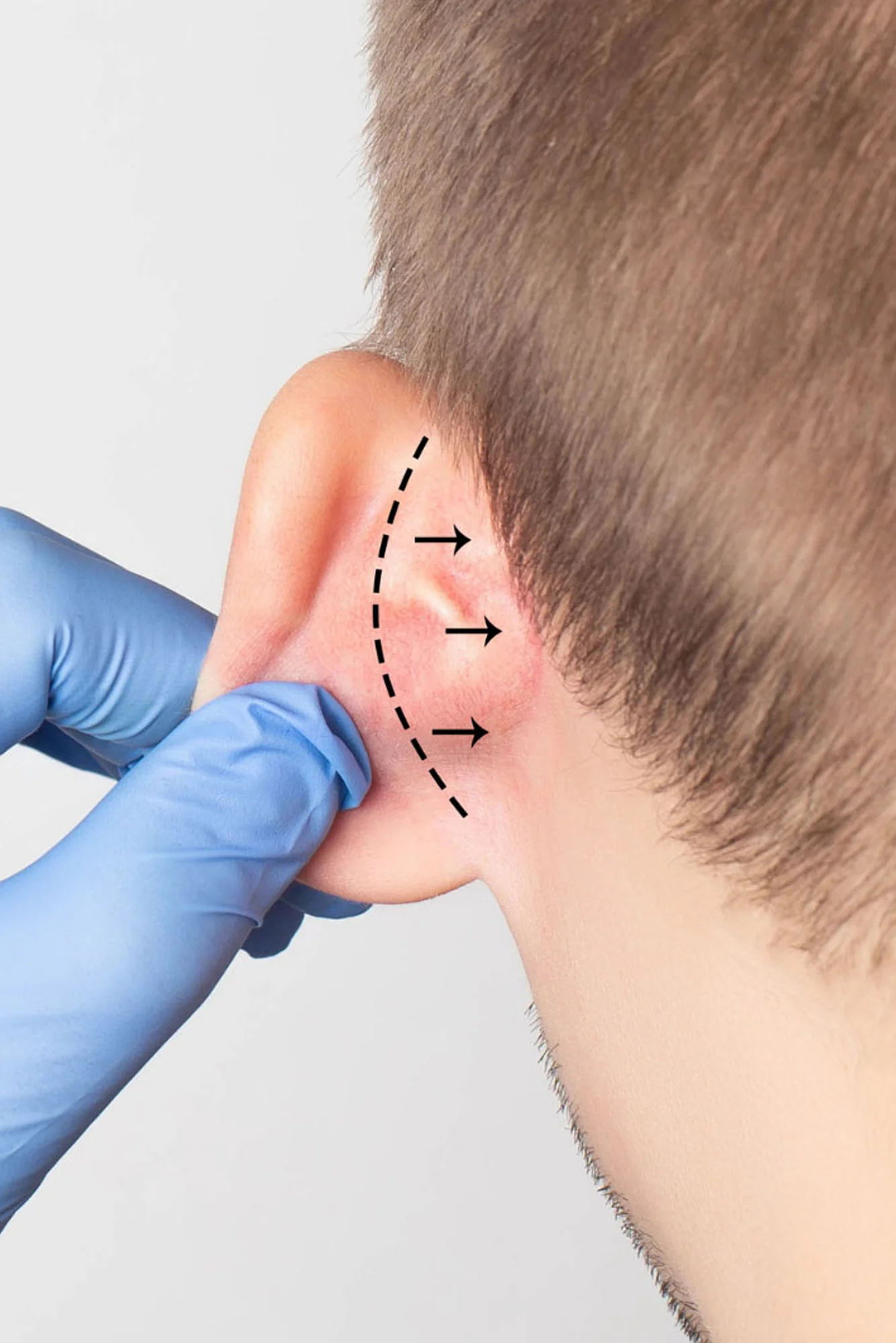 Marcación de plano de incisión y remodelación auricular para otoplastia con el Dr. Víctor González
