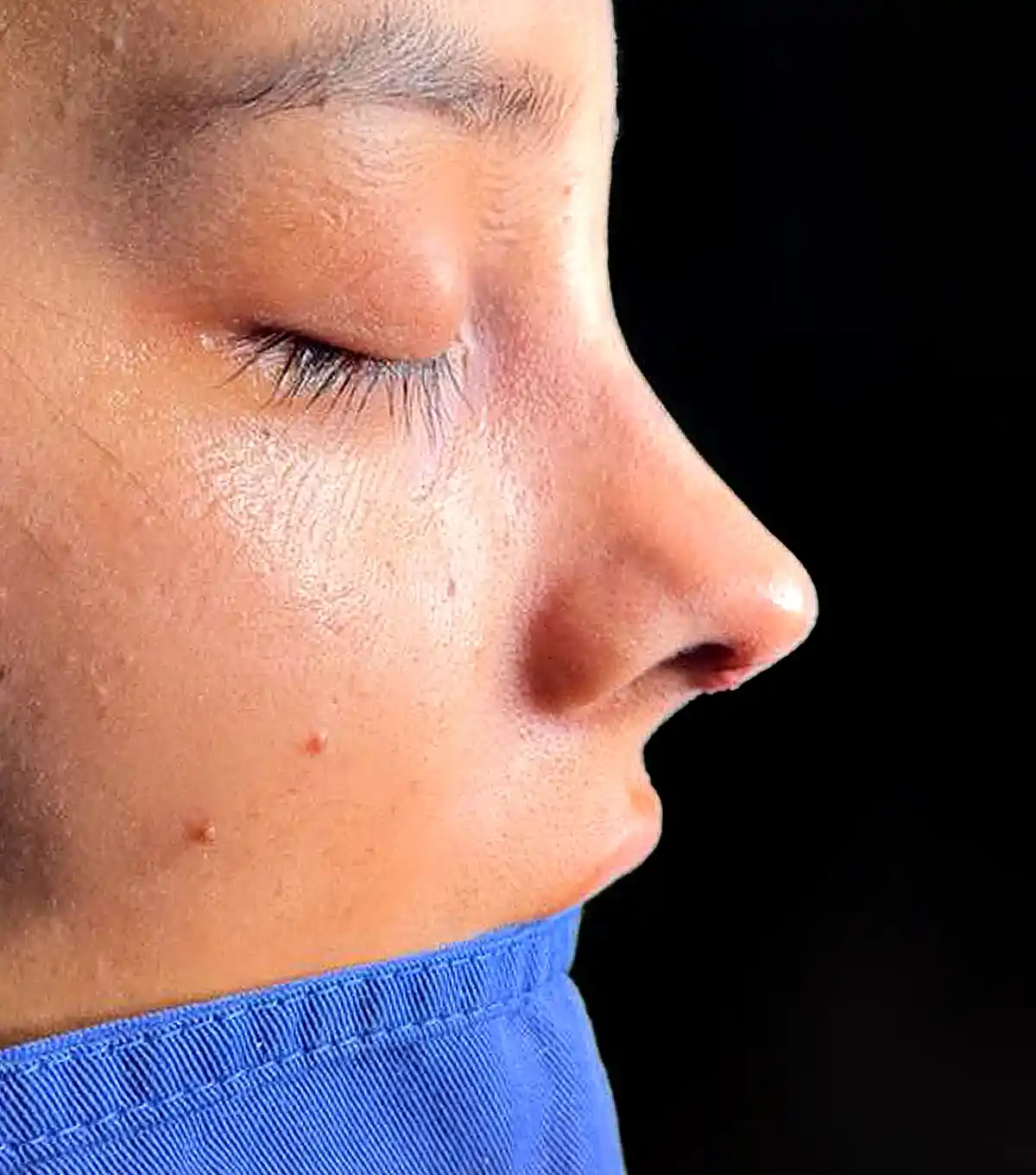 Perfilamiento y simetría nasal en vista lateral tras rinoplastia ultrasónica con el Dr. Víctor González