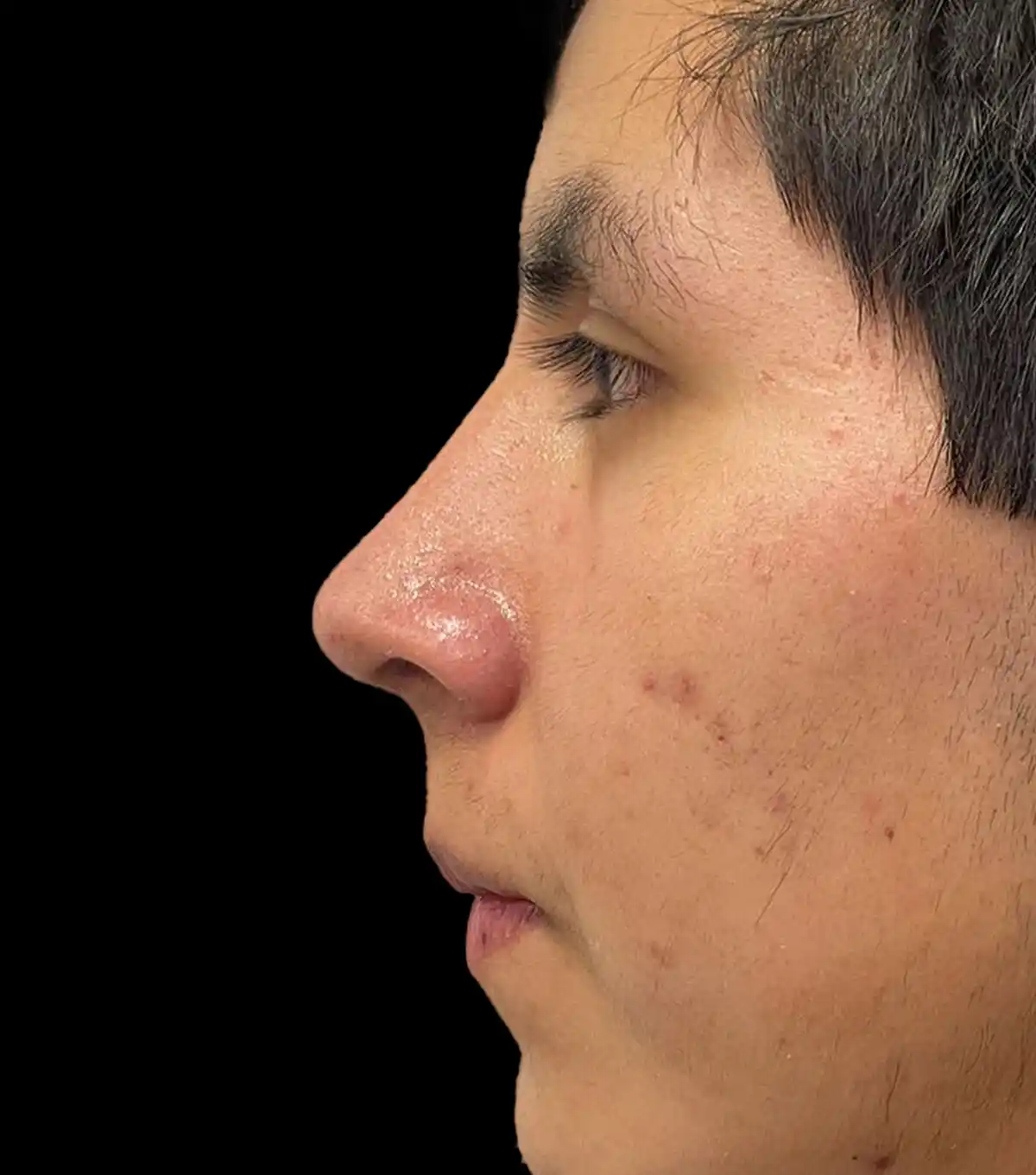 Resultado postoperatorio de perfil nasal tras rinoplastia ultrasónica con el Dr. Víctor González
