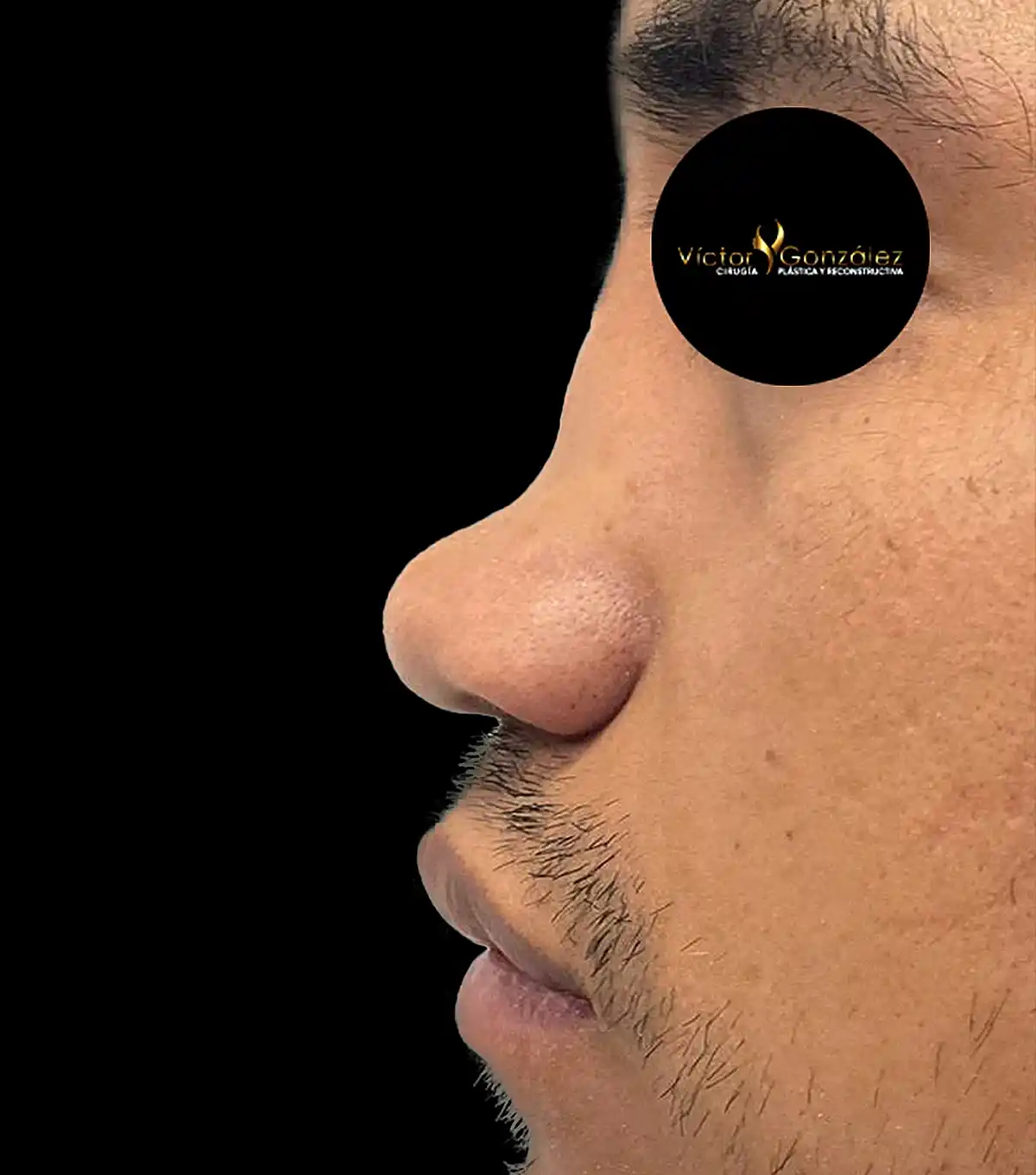 Perfilamiento nasal en paciente masculino tras rinoplastia ultrasónica con el Dr. Víctor González