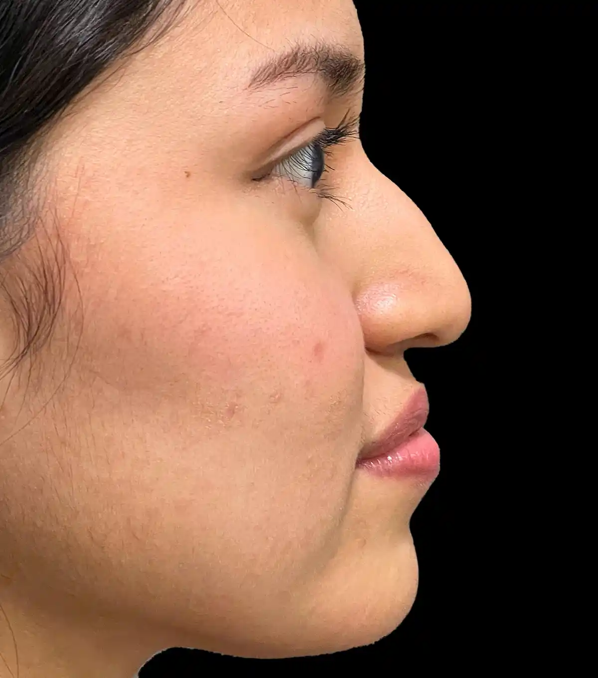 Perfil nasal antes de procedimiento de rinoplastia ultrasónica con el Dr. Víctor González