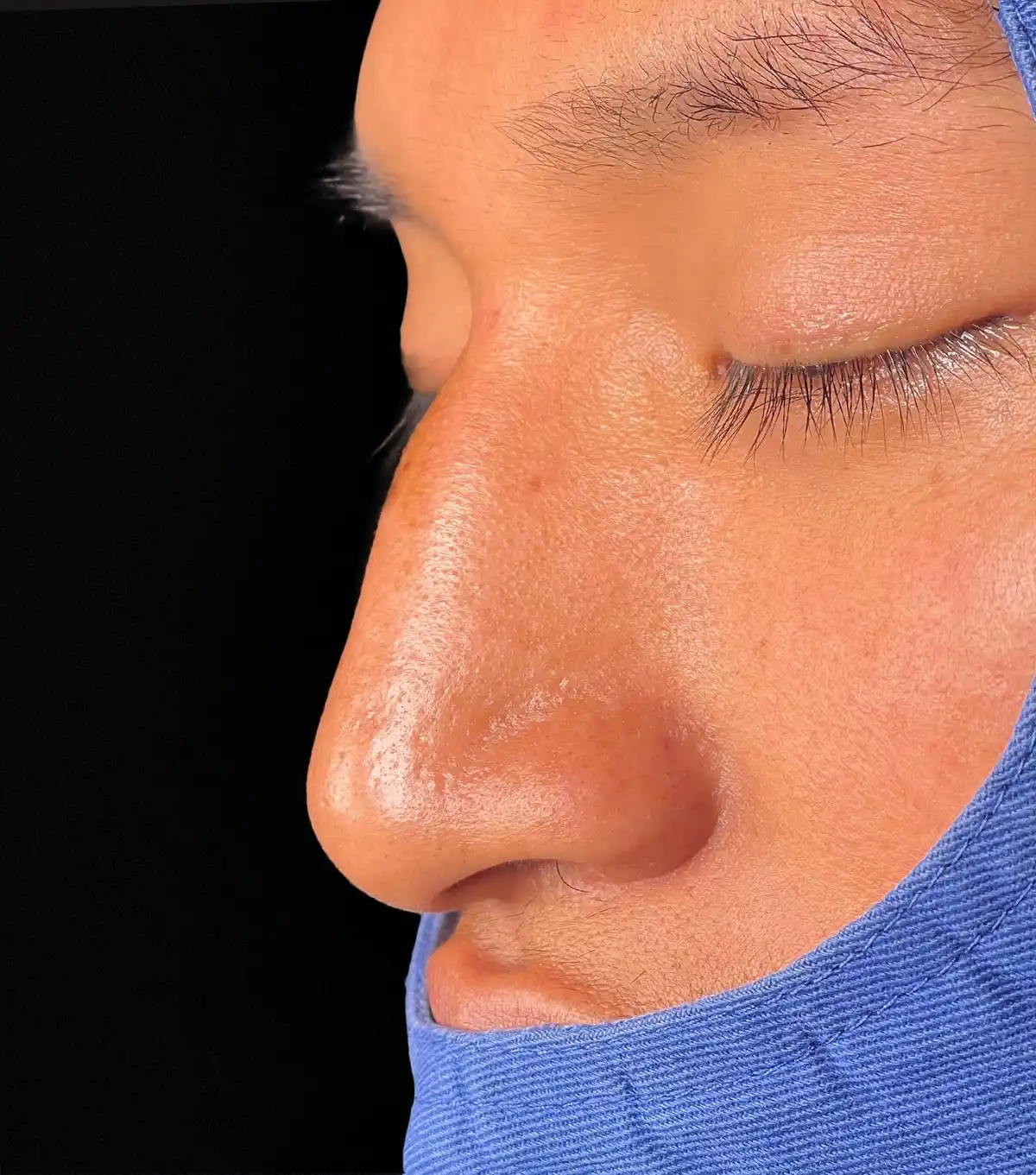 Aquí tienes los datos SEO para la imagen seleccionada (rino_ultra_11.webp): Datos de la imagen (rino_ultra_11.webp) Texto alternativo (Alt Text):Detalle de dorso y punta nasal en postoperatorio de rinoplastia ultrasónica con el Dr. Víctor González
