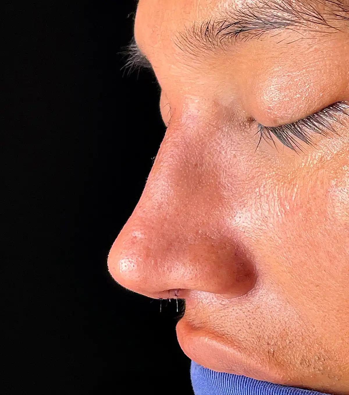 Ángulo de perfil preoperatorio para rinoplastia ultrasónica con el Dr. Víctor González