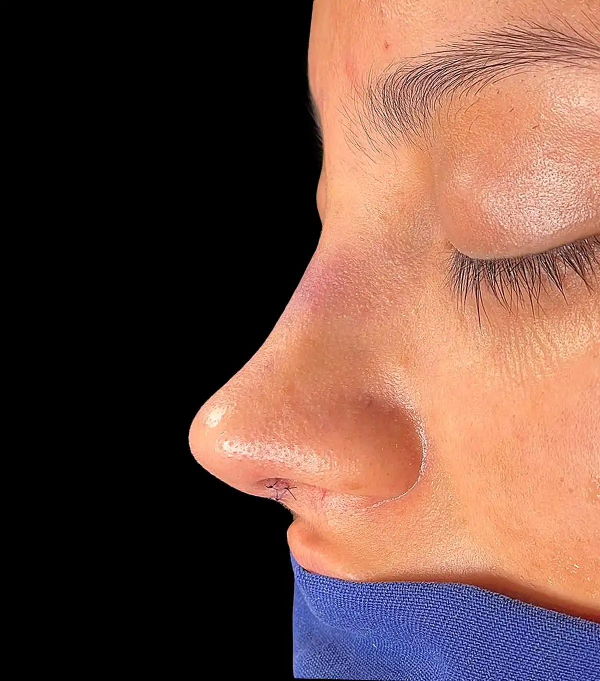Aquí tienes los datos SEO para la imagen seleccionada (rino_ultra_12.webp): Datos de la imagen (rino_ultra_12.webp) Texto alternativo (Alt Text):Perfil nasal preoperatorio para rinoplastia ultrasónica con el Dr. Víctor González