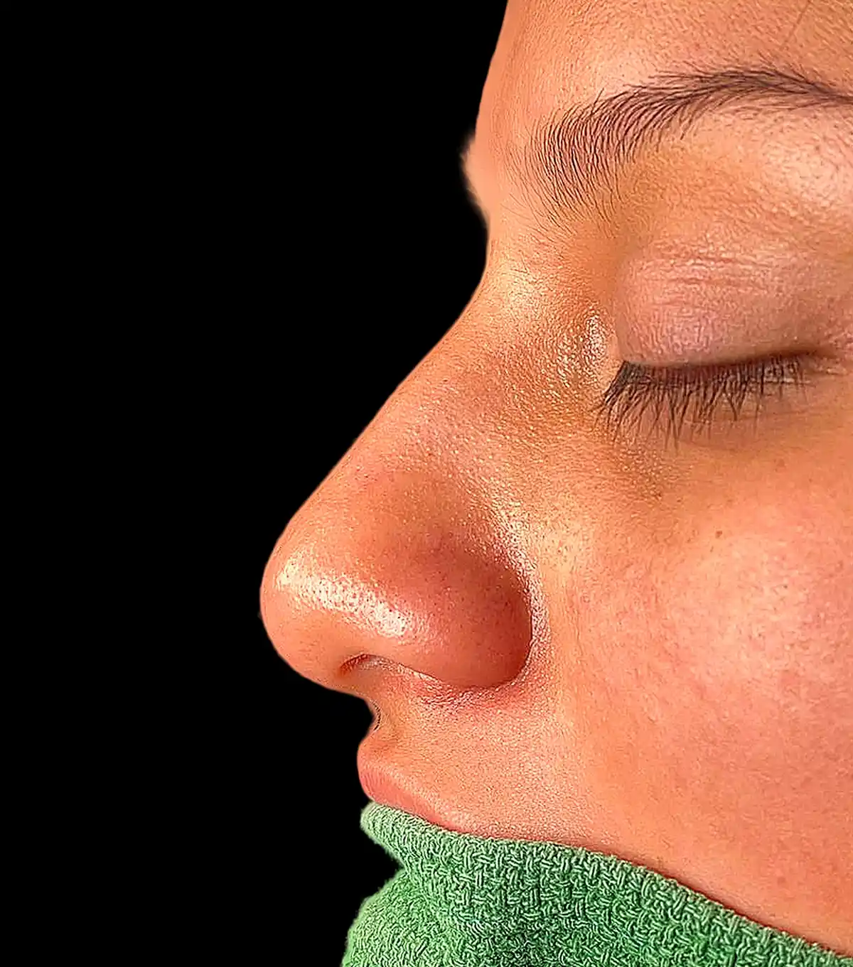 Aquí tienes los datos SEO para la imagen seleccionada (rino_ultra_12b.webp): Datos de la imagen (rino_ultra_12b.webp) Texto alternativo (Alt Text):Perfilamiento nasal postoperatorio de rinoplastia ultrasónica con el Dr. Víctor González