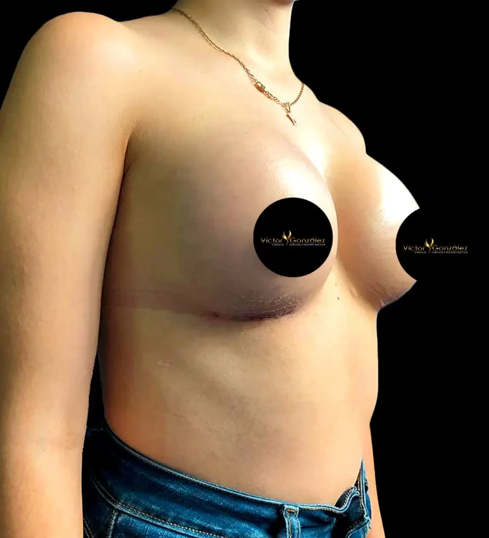 Aumento mamario y Mommy Makeover en Cuenca - Dr. Víctor González