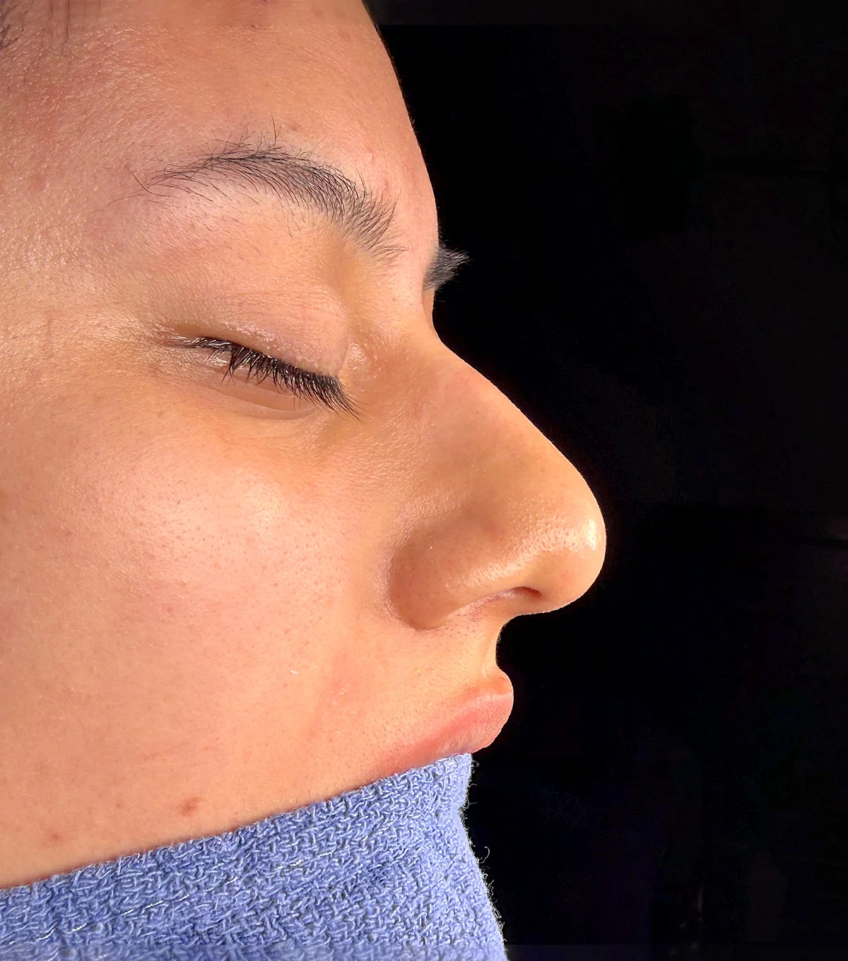 rino_ultra rinoplastia femenina, rinoplastia en cuenca, cirugia plastica cuenca, dr Victor Gonzalez, cirugia estetica nariz