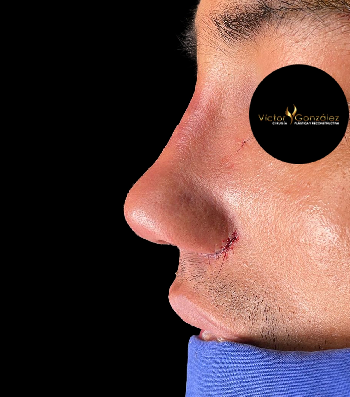 rino_ultra10 rinoplastia cuenca , rinoplastia ultrasonica en cuenca ecuador, cirujanos plastico en cuenca, cirugiaplastia en ecuador
