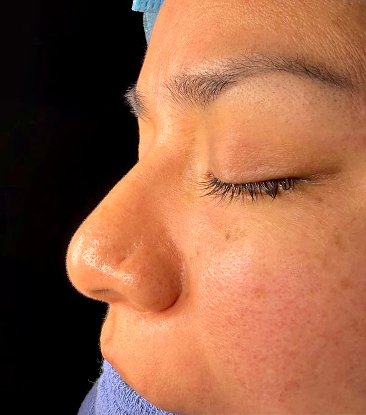 rino_ultra5 rinoplastia ultrasónica, nariz, cirugía estética, remodelación, cartílago, hueso, resultado, recuperación, postoperatorio, incisiones mínimas, cicatrices, precisión, contorno, mejora, estética facial, asimetría, rinoplastia ultrasónica, dr victor gonzaleez cirujano plasticvo certificado, rinoplastia en cuenca, rinoplastia cuenca, cirugia estetica
