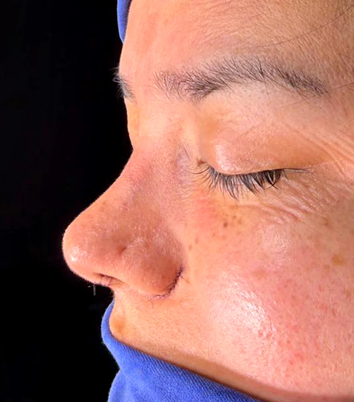 rino_ultra5 rinoplastia ultrasónica, nariz, cirugía estética, remodelación, cartílago, hueso, resultado, recuperación, postoperatorio, incisiones mínimas, cicatrices, precisión, contorno, mejora, estética facial, asimetría, rinoplastia ultrasónica, dr victor gonzaleez cirujano plasticvo certificado, rinoplastia en cuenca, rinoplastia cuenca, cirugia estetica