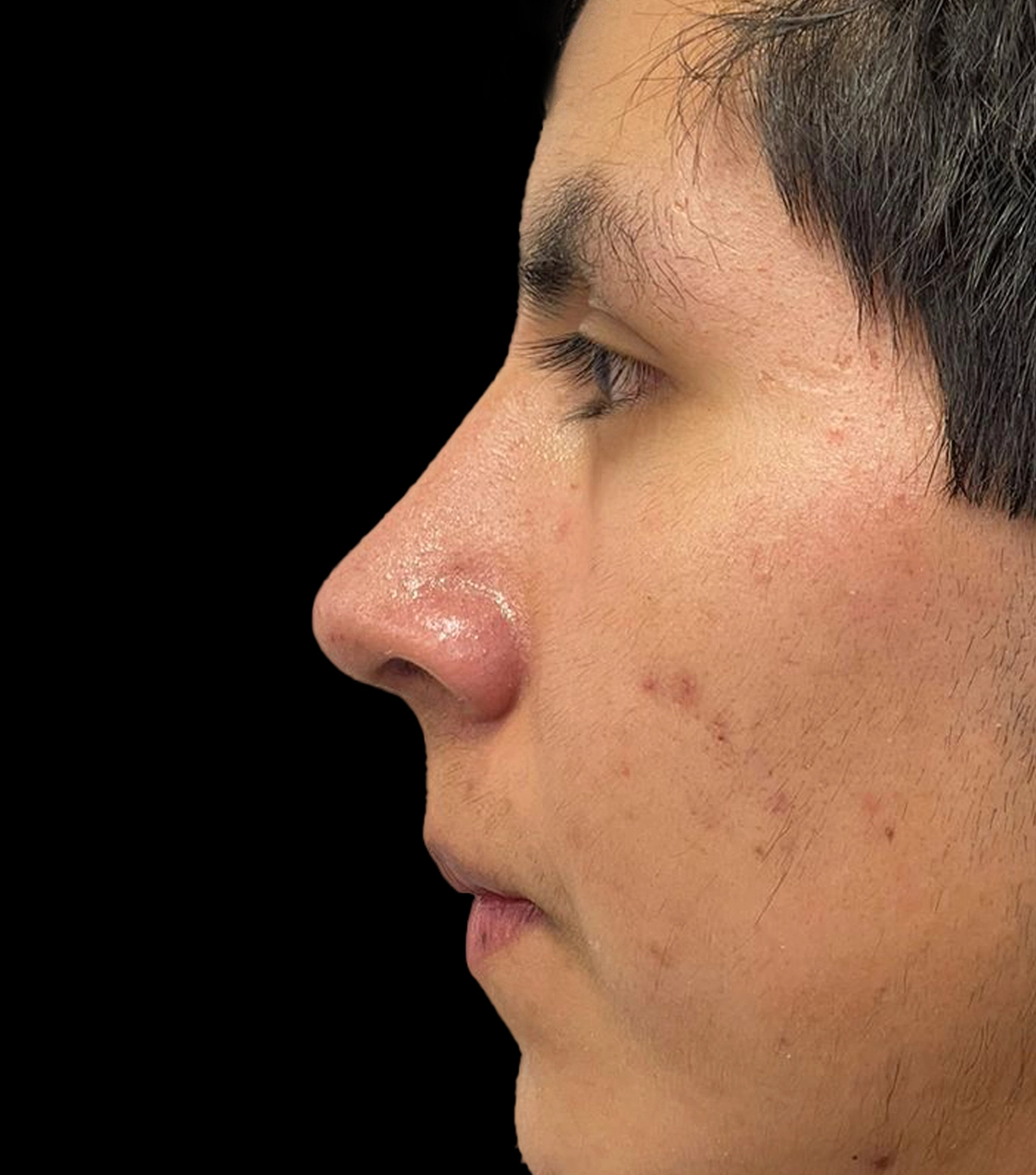 rino_ultra8. rinoplastia ultrasónica, nariz, cirugía estética, remodelación, cartílago, hueso, resultado, recuperación, postoperatorio, incisiones mínimas, cicatrices, precisión, contorno, mejora, estética facial, asimetría, rinoplastia ultrasónica, dr victor gonzaleez cirujano plasticvo certificado, rinoplastia en cuenca, rinoplastia cuenca, cirugia estetica