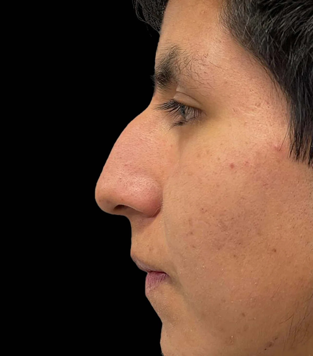 rino_ultra8. rinoplastia ultrasónica, nariz, cirugía estética, remodelación, cartílago, hueso, resultado, recuperación, postoperatorio, incisiones mínimas, cicatrices, precisión, contorno, mejora, estética facial, asimetría, rinoplastia ultrasónica, dr victor gonzaleez cirujano plasticvo certificado, rinoplastia en cuenca, rinoplastia cuenca, cirugia estetica